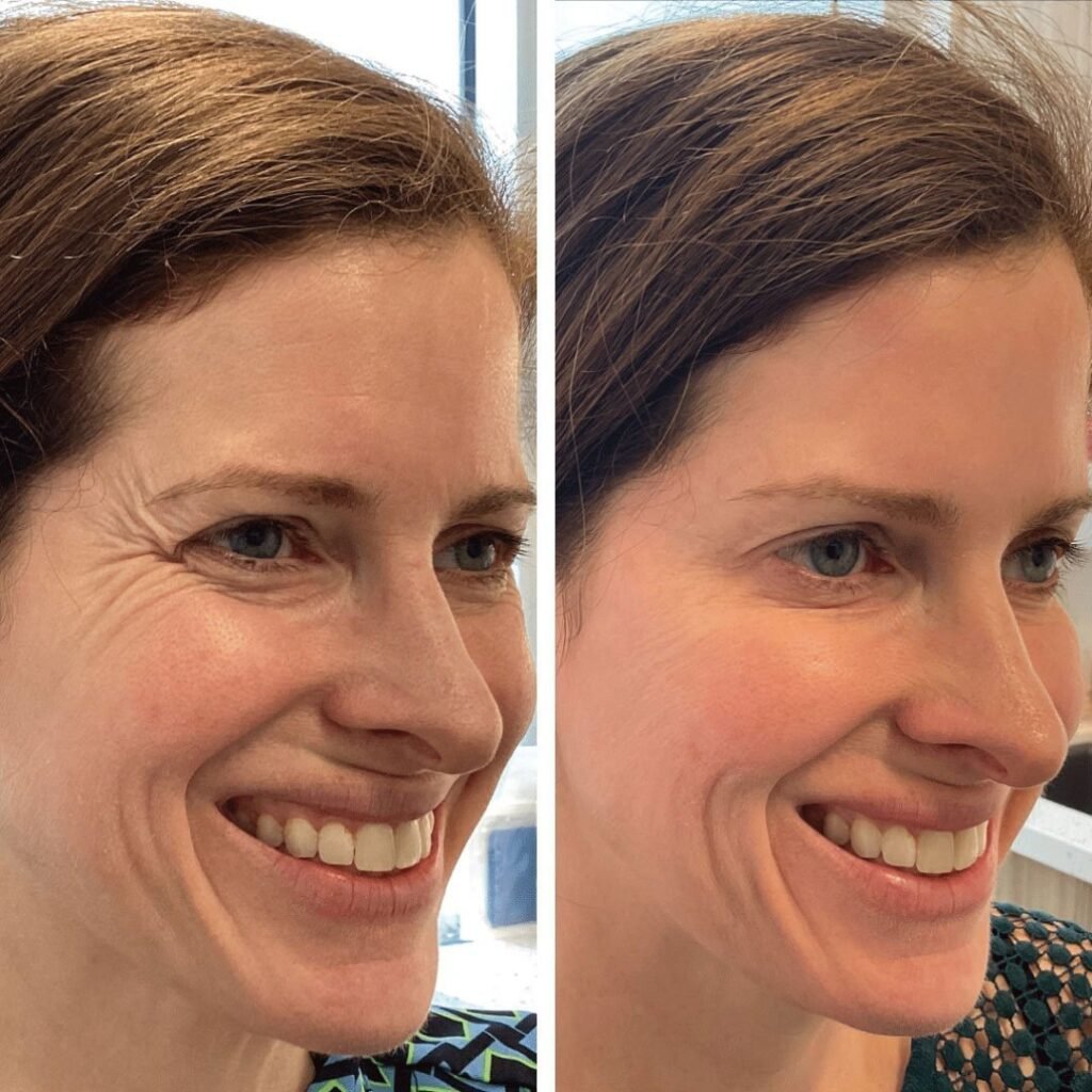 Botox_1_1080x1080.jpg